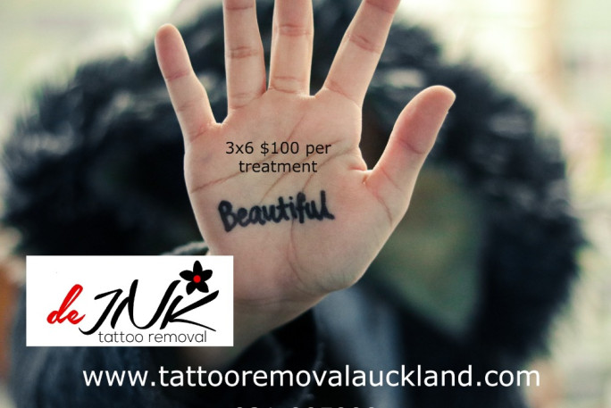 Laser Tattoo Removal Business for Sale Auckland