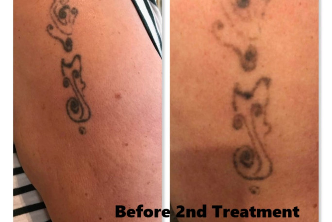 Laser Tattoo Removal Business for Sale Auckland 